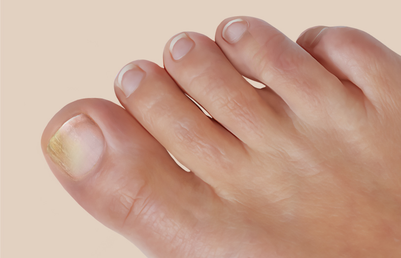 URGO - Comment attrape-t-on une mycose de l'ongle