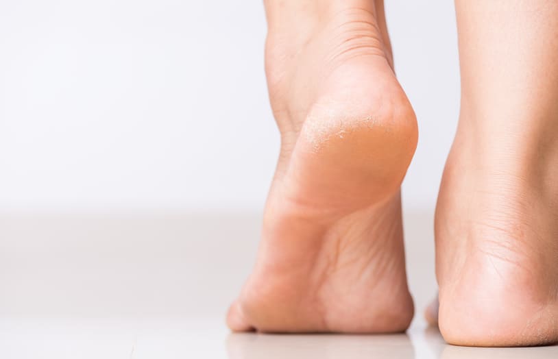 URGO-Quelles sont les causes des pieds très secs