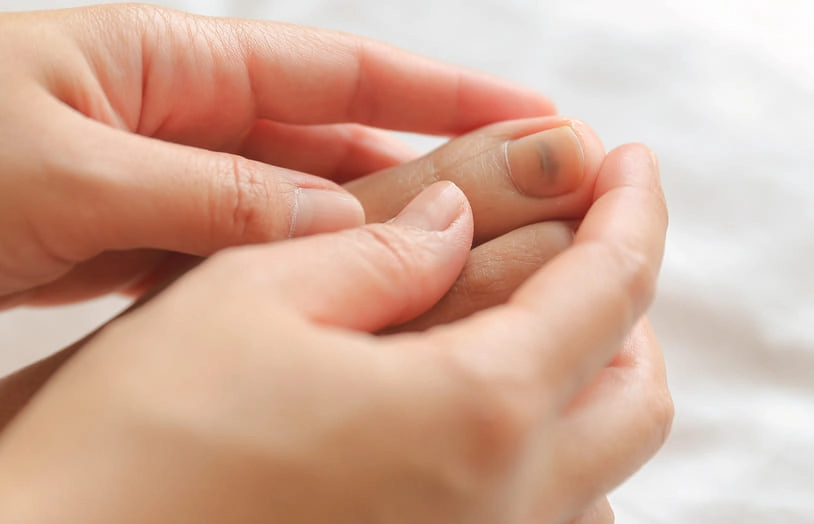 Mycoses et traumatismes légers des ongles