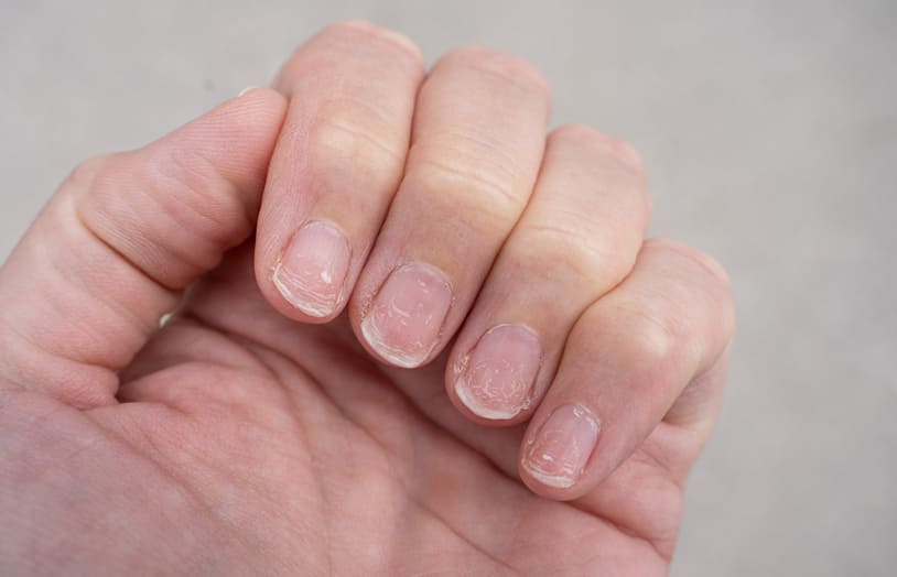 URGO - Comment les ongles se fragilisent - conseil