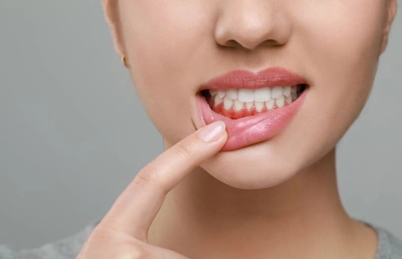 URGO-Comment prevenir la gingivite