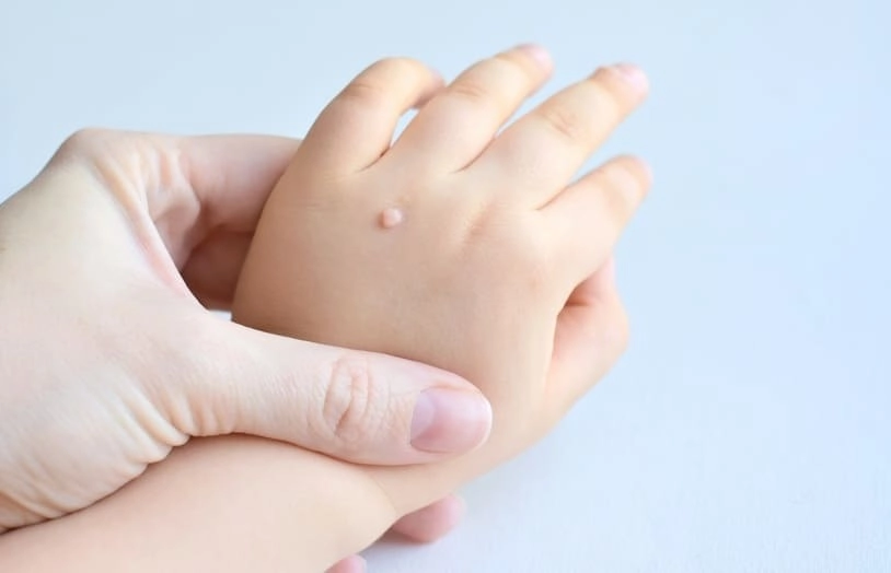 URGO-Comment reconnaître, éviter ou se débarrasser d'une verrue