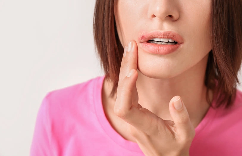 URGO-Est-ce qu'un bouton de fièvre est contagieux