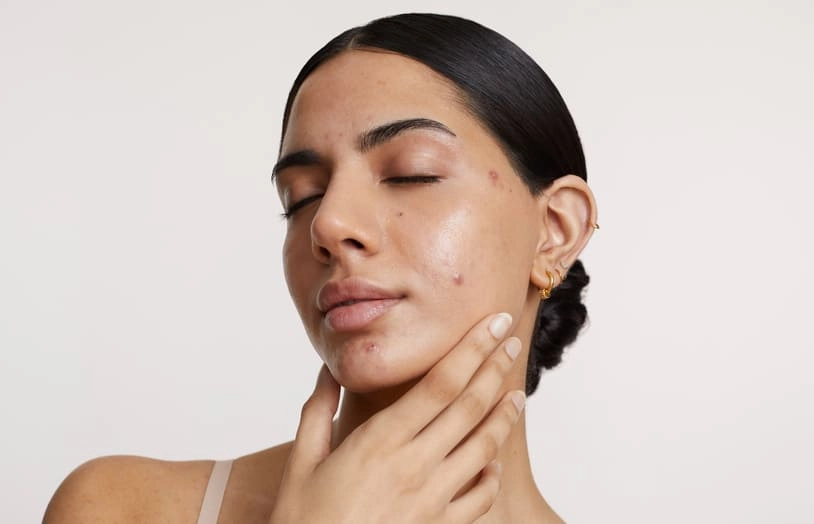 URGO-Mieux comprendre l'acné