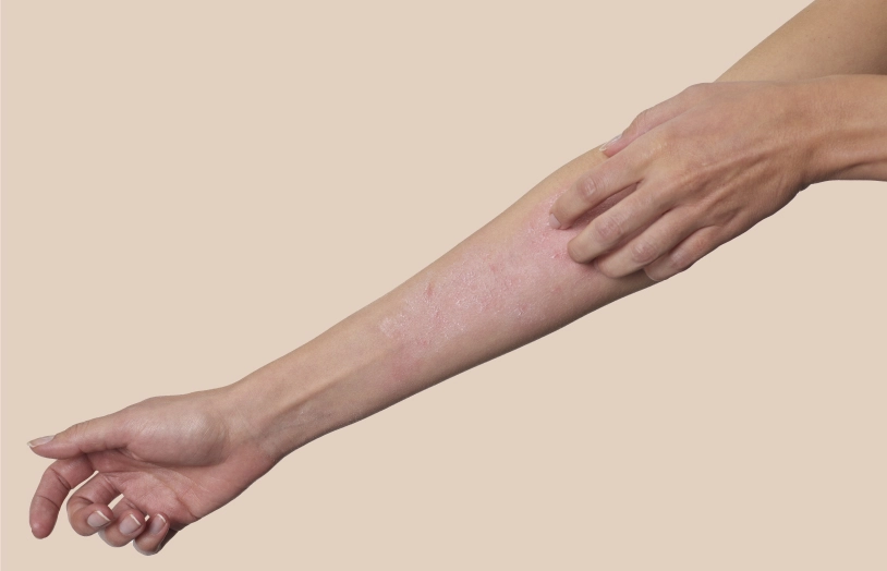 URGO - Mieux comprendre l'eczéma atopique 