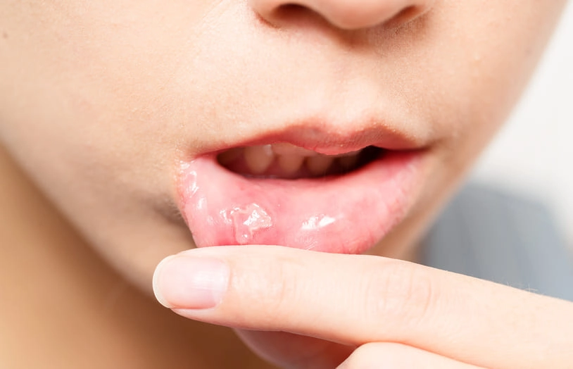 URGO-Mieux comprendre les aphtes