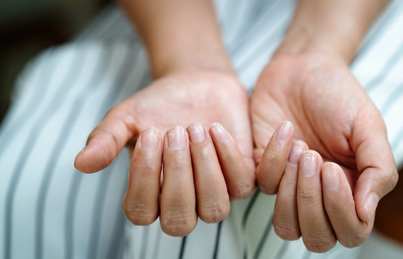 URGO-Ongles dédoublés que faire