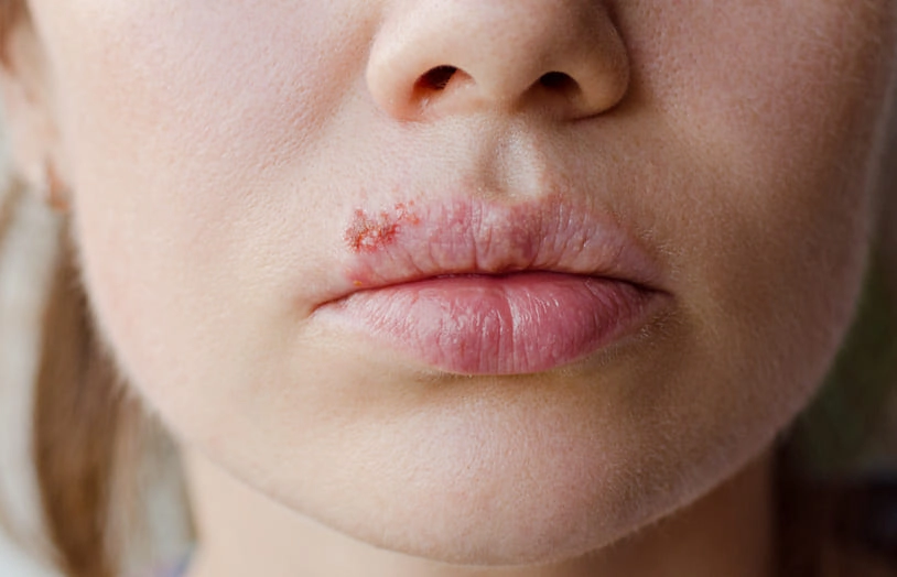 URGO-Que faire à l'apparition d'un bouton de fievre