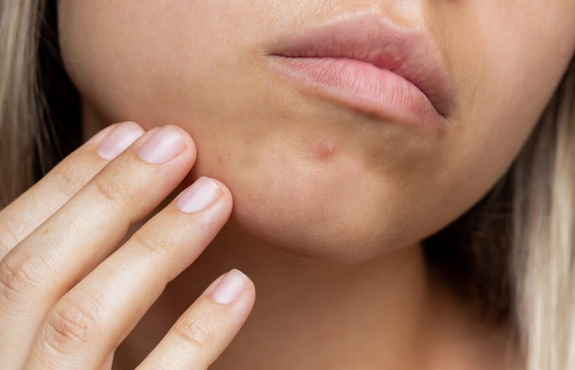 URGO_Comment faire disparaitre un bouton