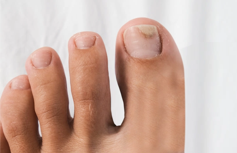 URGO_Comment prevenir et soigner les ongles abimes par mycoses et traumatismes legers