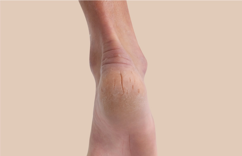 URGO_Pieds tres secs, crevasses, que faire