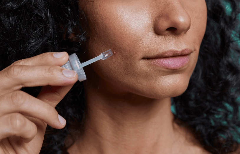 Acne-comment-faire-disparaitre-les-boutons