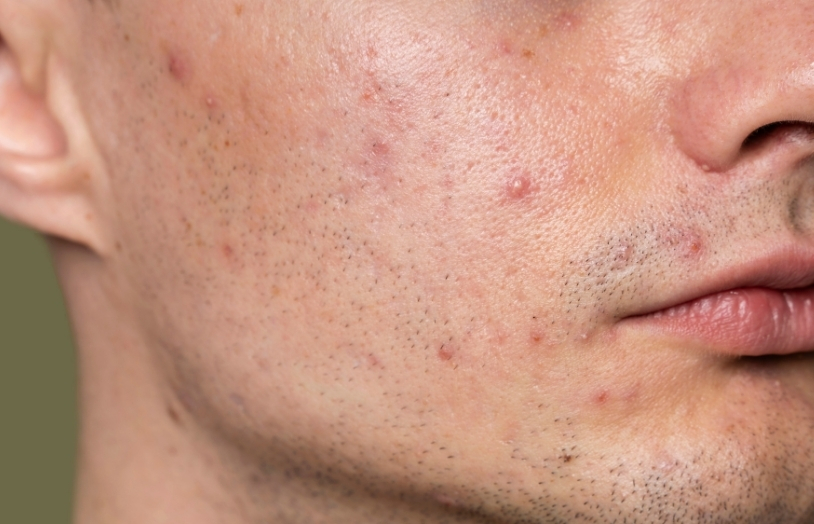 URGO boutons localisés visage