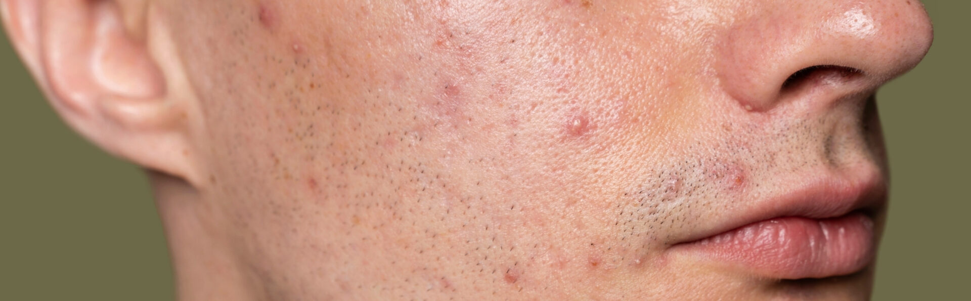 URGO cibler les imperfections visage boutons localisés