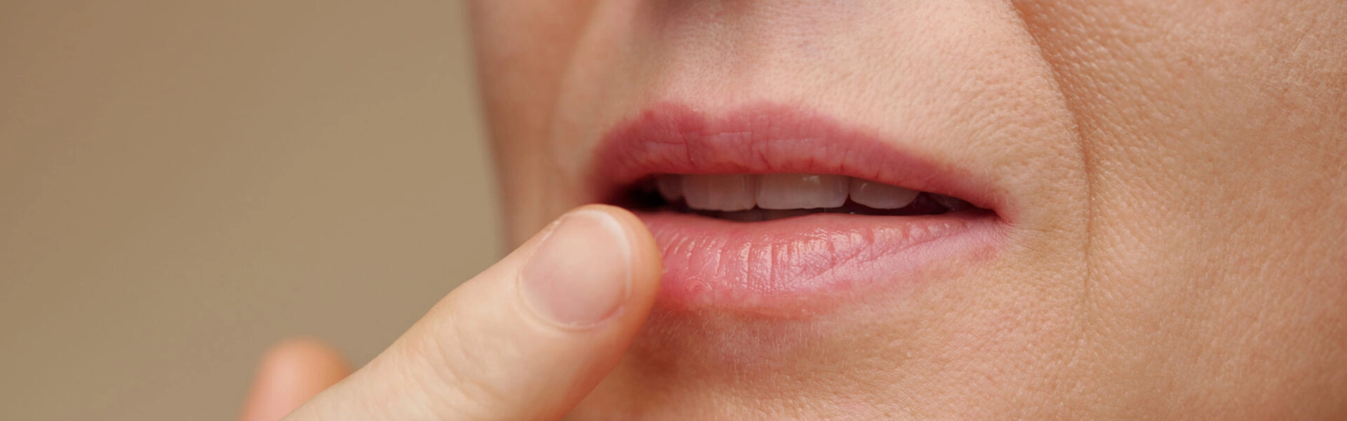 Fissures levres - causes preventions et solutions pour apaiser et soulager