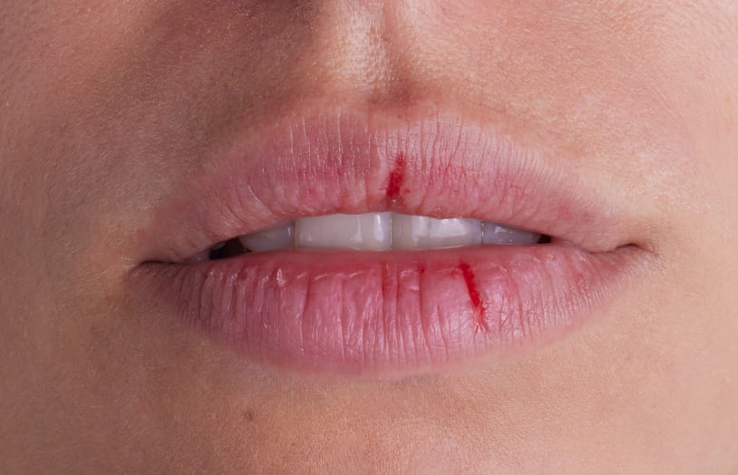 Lèvres abîmées, fissurées  les prévenir et les réparer