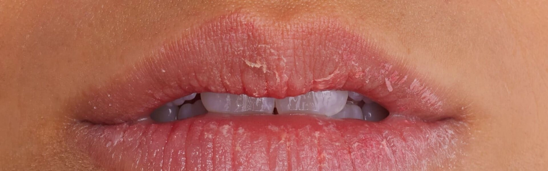 Stades de la secheresse des levres