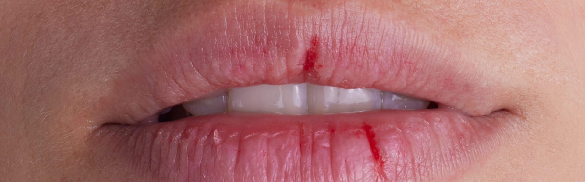 Urgo - Lèvres abîmées, fissurées  les prévenir et les réparer