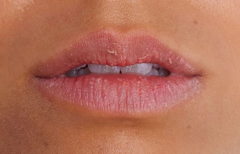 URGO - stades secheresse levres