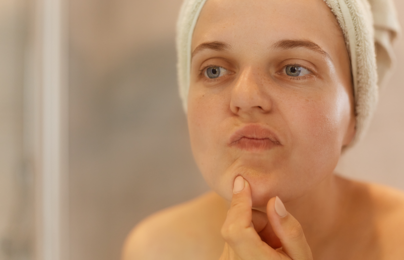 Boutons visage adulte à 30 ans URGO